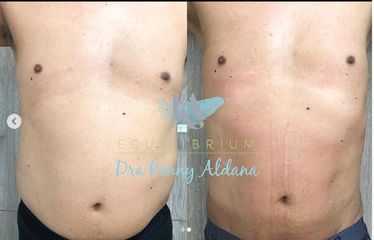 Mesoterapia - Dra. Konny Aldana