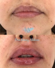 Aumento de labios - Dra. Konny Aldana