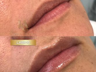 Aumento de labios antes y después - 875978