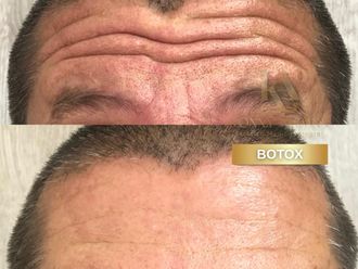 Bótox antes y después - 875979