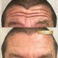 Botox- Dra. Konny Aldana