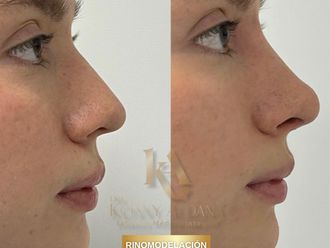 Rinomodelación antes y después - 876640