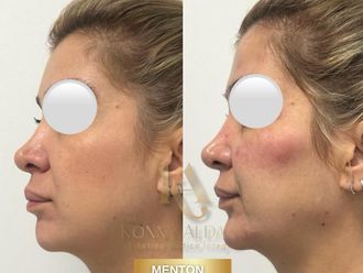 Rejuvenecimiento facial antes y después - 876641