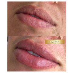 Aumento de labios - Dra. Konny Aldana