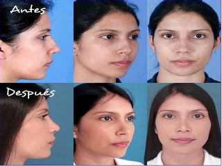 RINOPLASTIA PRIMARIA