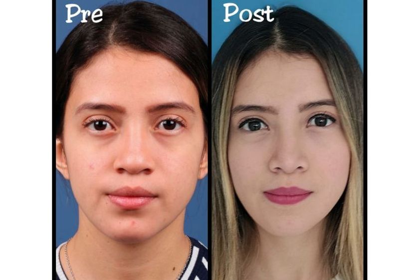 Bichectomía antes y después - 688042