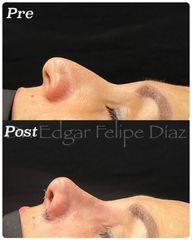 Rinoplastia - Dr. Edgar Felipe Díaz