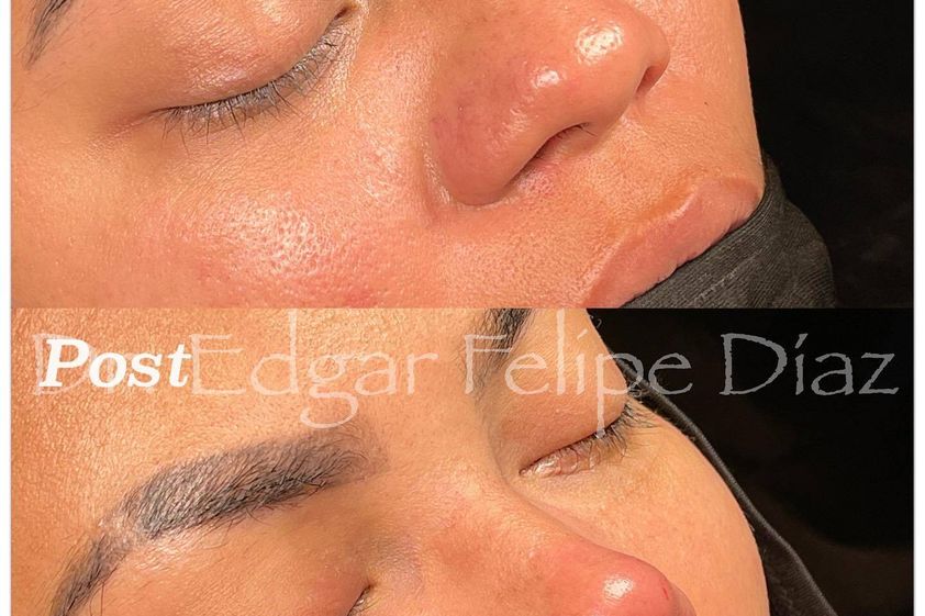 Rinoplastia antes y después - 851065