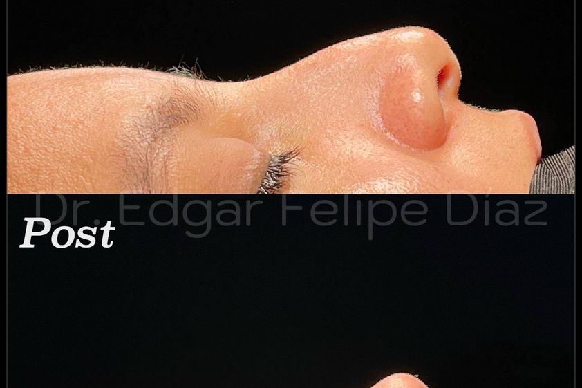 Rinoplastia antes y después - 851069