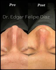 Rinoplastia - Dr. Edgar Felipe Díaz
