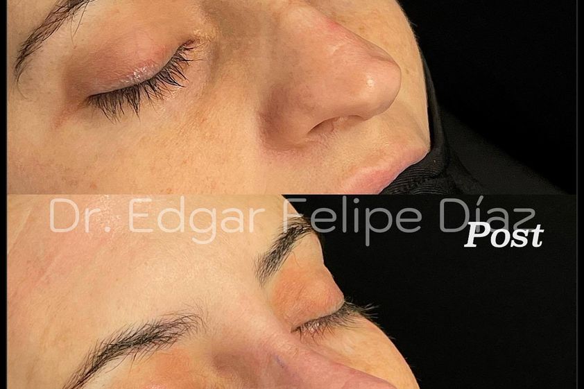Rinoplastia antes y después - 851076