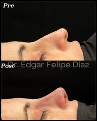 Rinoplastia - Dr. Edgar Felipe Díaz