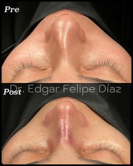 Rinoplastia - Dr. Edgar Felipe Díaz