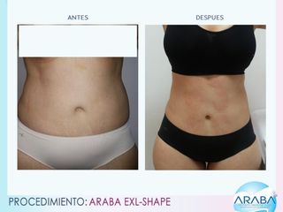 testimonio exl-shape barranquilla dra angela gonzalez araba clinic 