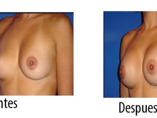 Mamoplastia