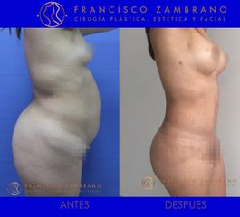 Liposuccion, lipectomia ,mamoplastia de aumento , lipoinyeccion glutea 