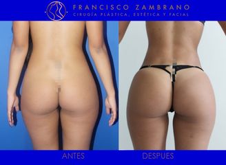 Liposucción, lipoinyección glútea y marcación abdominal