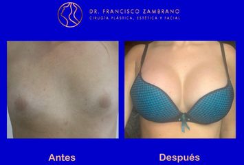 Mamoplastia de aumento / Volumen del implante 350 cc lisos