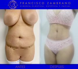 Liposucción, lipectomia y lipoinyeccion glútea 