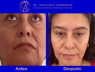 Blefaroplastia - 661094