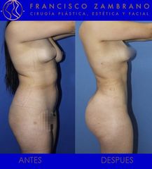 Liposucción, lipoinyección glútea y marcación abdominal