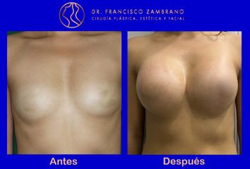 Mamoplastia de aumento con Volumen del implante 350  cc lisos 