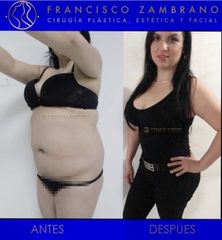 Liposucción, lipectomia y lipoinyección glútea 