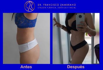 Liposucción, lipectomia con marcación abdominal, lipoinyección glútea