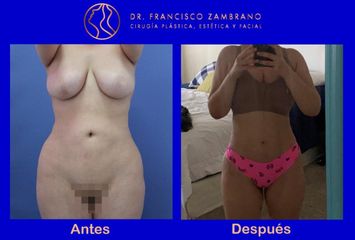 Eliminacion de fibrosis, pexia mamaria y lipoinyección glútea