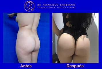 Aumento gluteo (Resultados naturales)