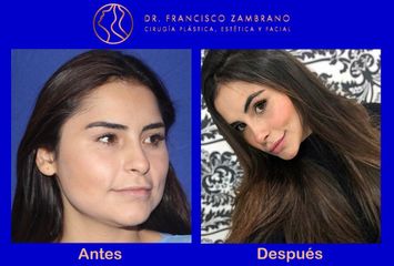 Rejuvenecimiento facial  (Resultados naturales)