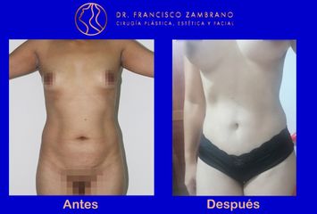 Liposuccion, lipectomia con marcacion abdominal ,mamoplastia de aumento , lipoinyeccion glutea 