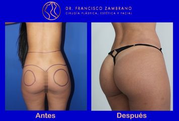 Lipoinyeccion glutea (Resultados naturales)