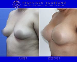 Dr. Francisco Zambrano - Mamoplastia de aumento 