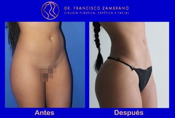 Dr. Francisco Zambrano - Liposuccion, lipoinyeccion glutea, marcacion abdominal