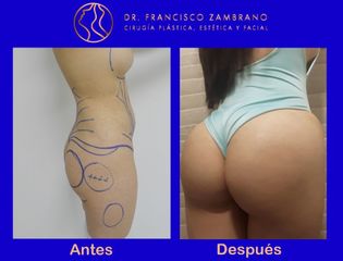 Dr. Francisco Zambrano - Liposucción, lipectomia , lipoinyeccion glutea (Resultados naturales)