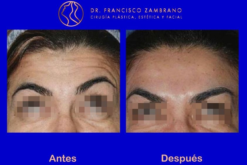 Bótox antes y después - 661465