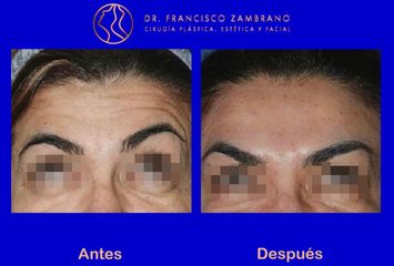 Dr. Francisco Zambrano - Rejuvenecimiento facial  (Resultados naturales)