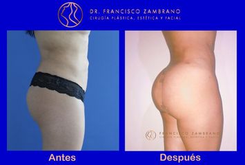 Dr. Francisco Zambrano - Aumento de glúteos