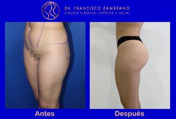 Dr. Francisco Zambrano - Liposuccion, lipoinyeccion glutea, marcacion abdominal