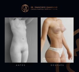 Dr. Francisco Zambrano - Liposuccion, lipoinyeccion glutea, marcacion abdominal