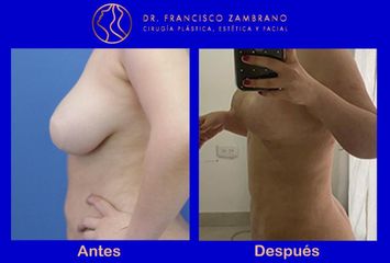 Dr. Francisco Zambrano - Mamoplastia de reducción
