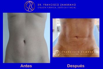 Dr. Francisco Zambrano - Liposuccion, lipoinyeccion glutea, marcacion abdominal
