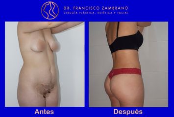 Dr. Francisco Zambrano - Lipoescultura