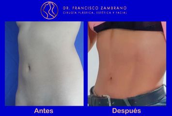 Dr. Francisco Zambrano - Liposuccion, lipoinyeccion glutea, marcacion abdominal