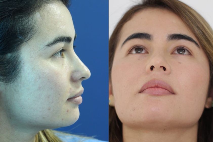 Rinoplastia antes y después - 661480