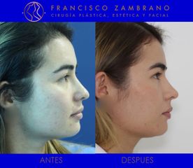 Dr. Francisco Zambrano - Rinoplastia