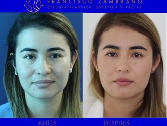 Rinoplastia - 661484