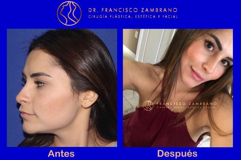 Bichectomía antes y después - 661616