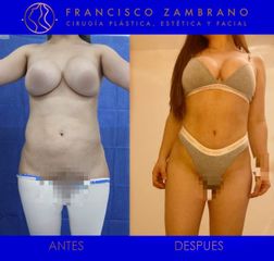 Dr. Francisco Zambrano - Liposuccion, lipoinyeccion glutea, marcacion abdominal